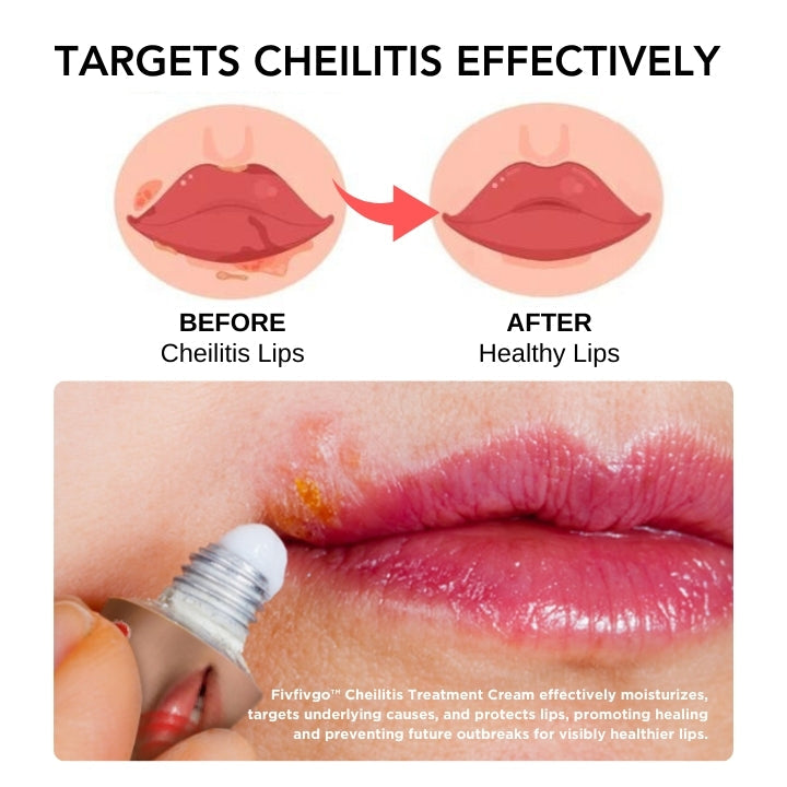 Fivfivgo™ Cheilitis Behandlung Creme