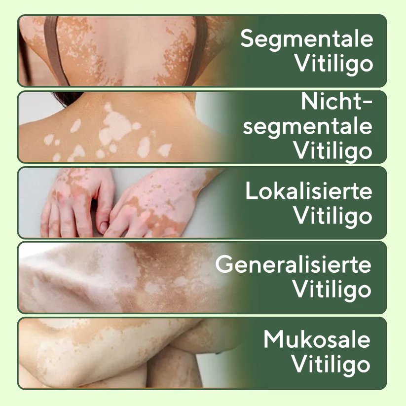 Fivfivgo® Vitiligo-Behandlungssalbe
