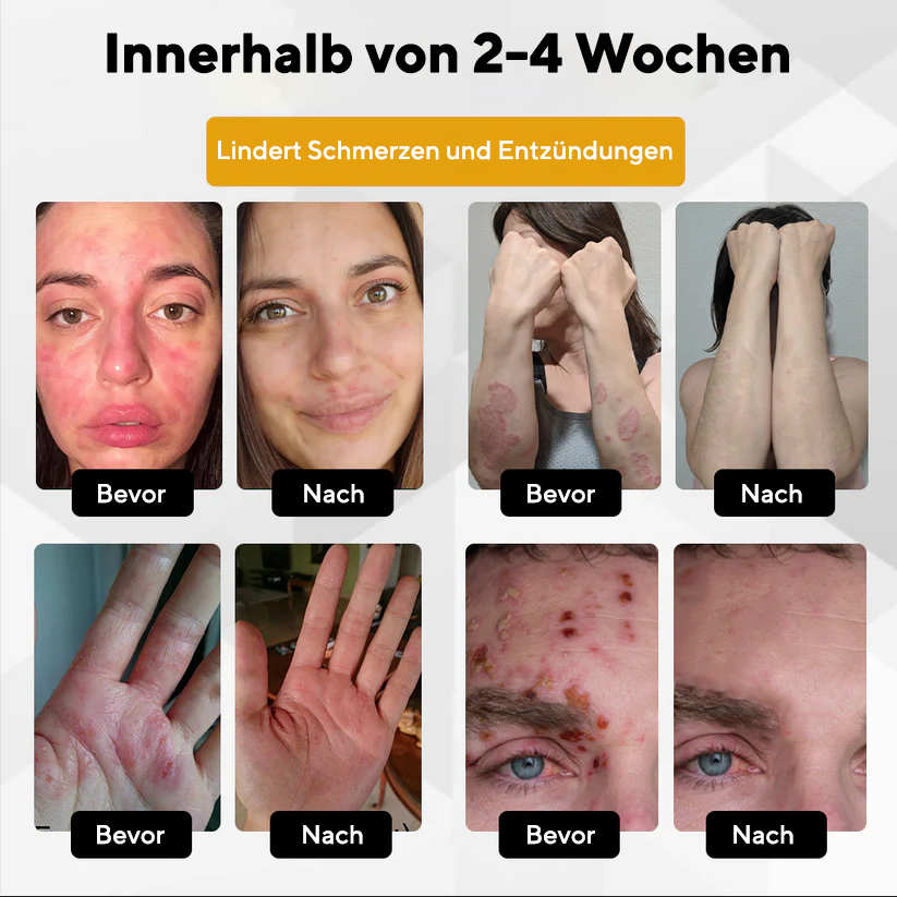 Fivfivgo® NervoRelief Gürtelrose-Heilsalbe