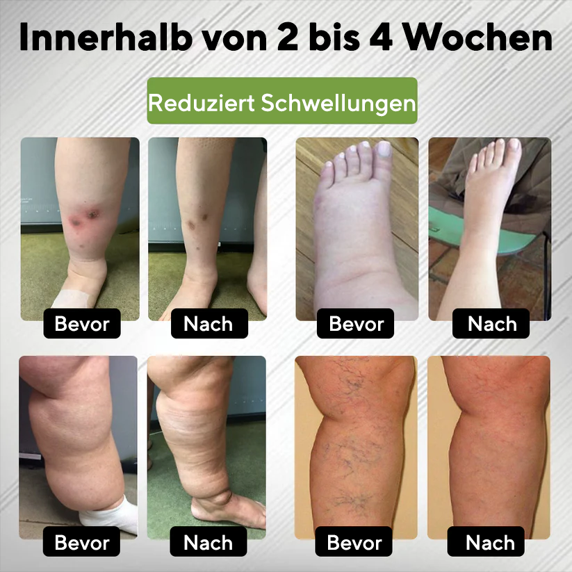 NovaRX® Ödem Drain Duo Therapie-Rollercreme