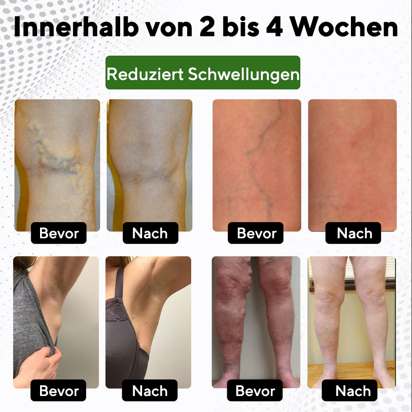 NovaRX® FluidQuit Ödem-Unterstützungsspray