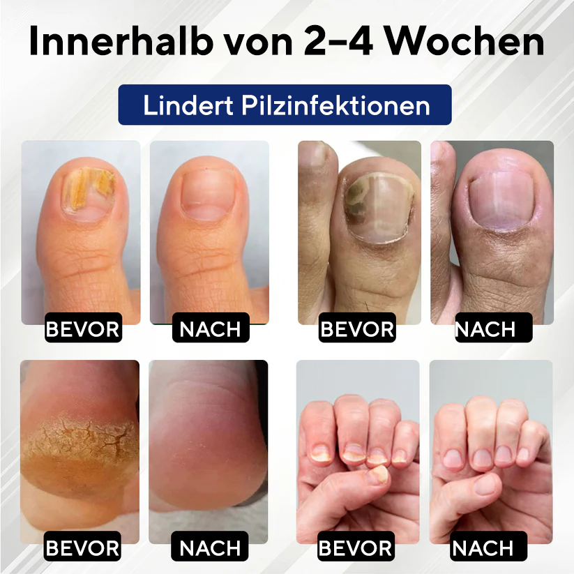 Fivfivgo® MycoStop Nagel-Reparatur-Serum-Stift