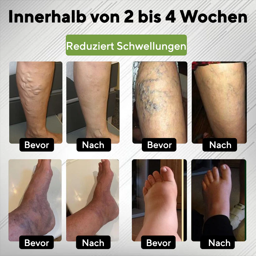 NovaRX® Ödem Drain Duo Therapie-Rollercreme