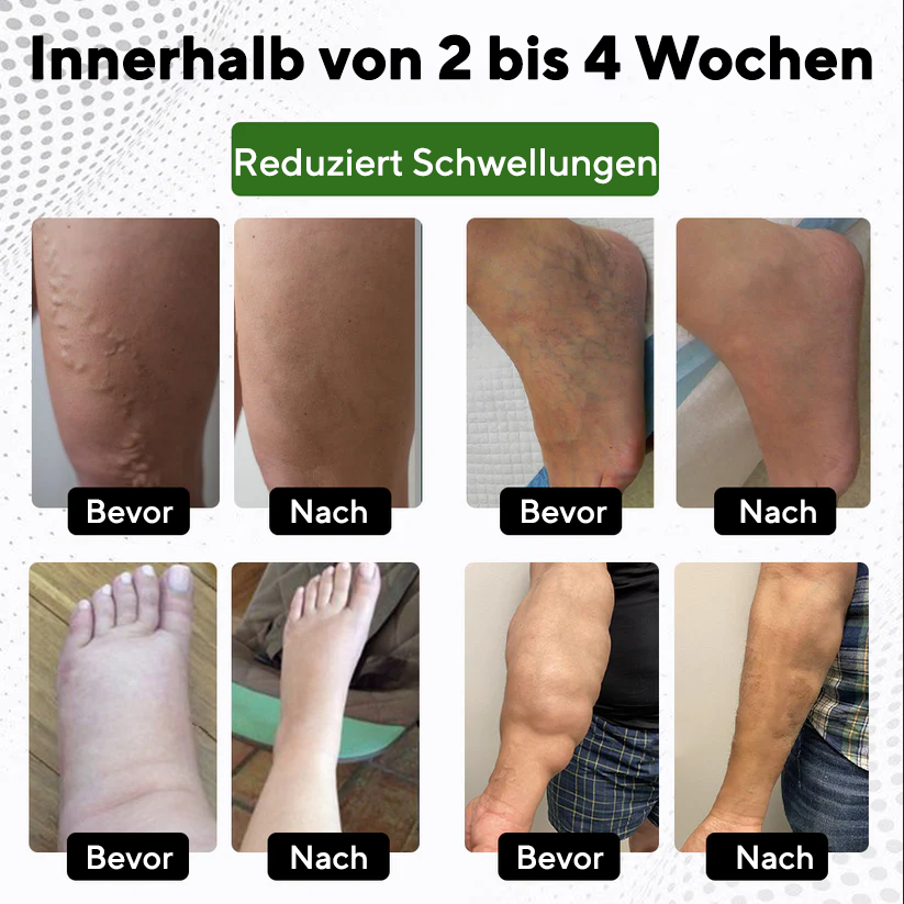 NovaRX® FluidQuit Ödem-Unterstützungsspray