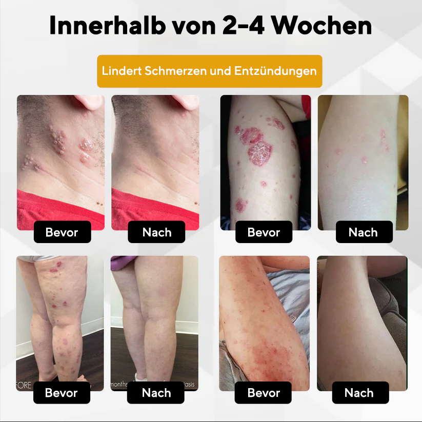 Fivfivgo® NervoRelief Gürtelrose-Heilsalbe
