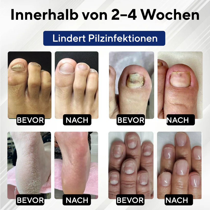 Fivfivgo® MycoStop Nagel-Reparatur-Serum-Stift