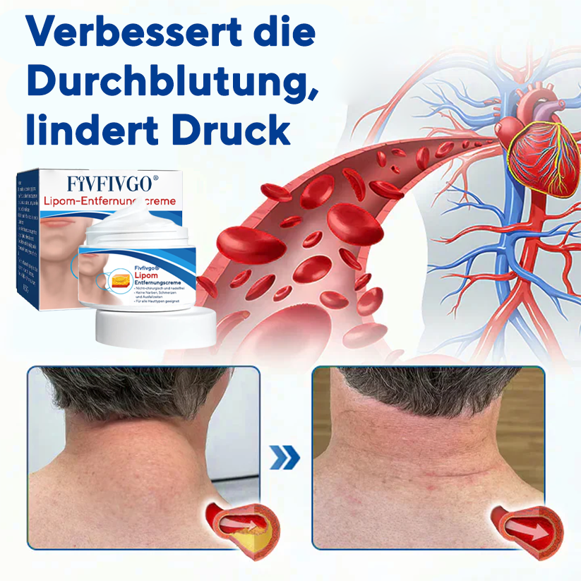 Fivfivgo® Lipom-Entfernungscreme