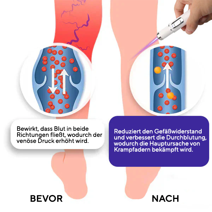 Fivfivgo® Krampfadern Photothermische Laserbehandlung