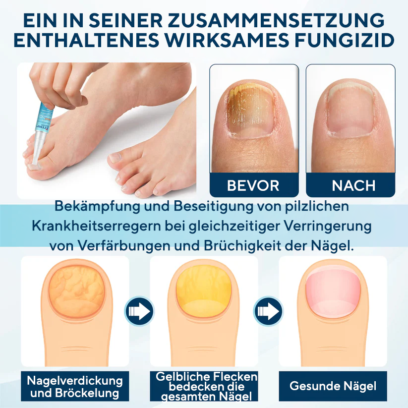 Fivfivgo® MycoStop Nagel-Reparatur-Serum-Stift