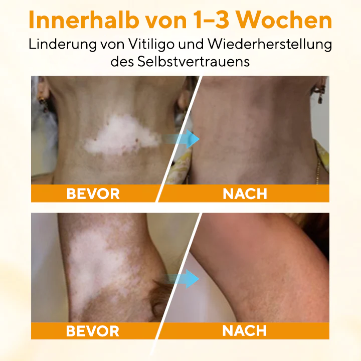 Oveallgo® VitiGone Schnellspray