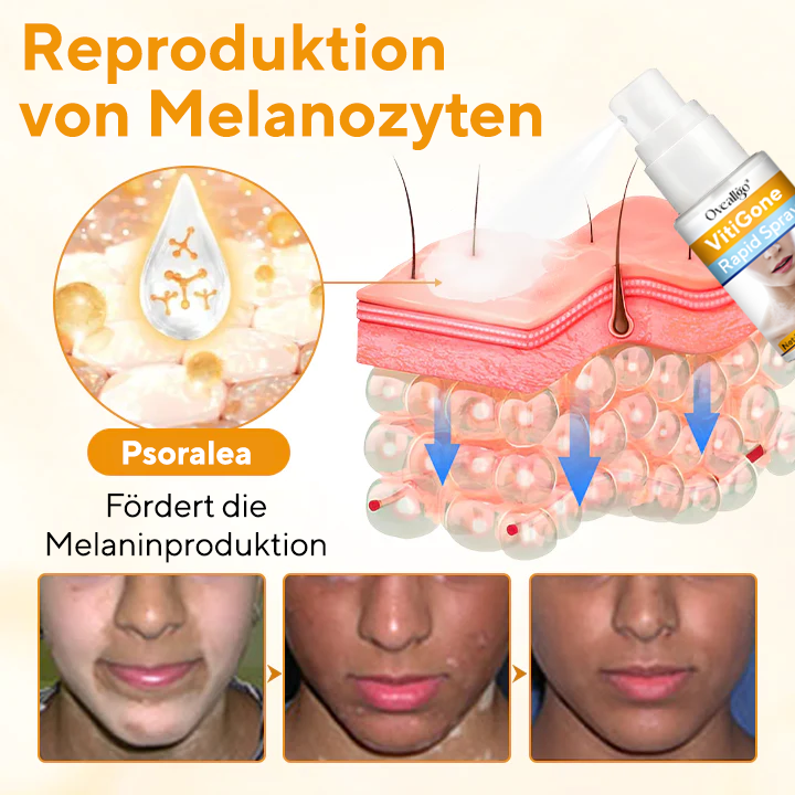 Oveallgo® VitiGone Schnellspray