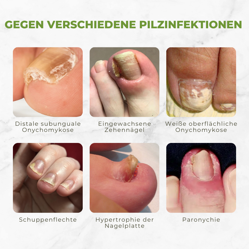Fivfivgo™ FungiVanish Bienengift-Nagelbehandlungsöl