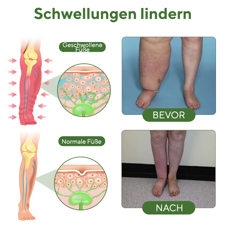 NovaRX® FluidEase Beintherapie-Ödemcreme