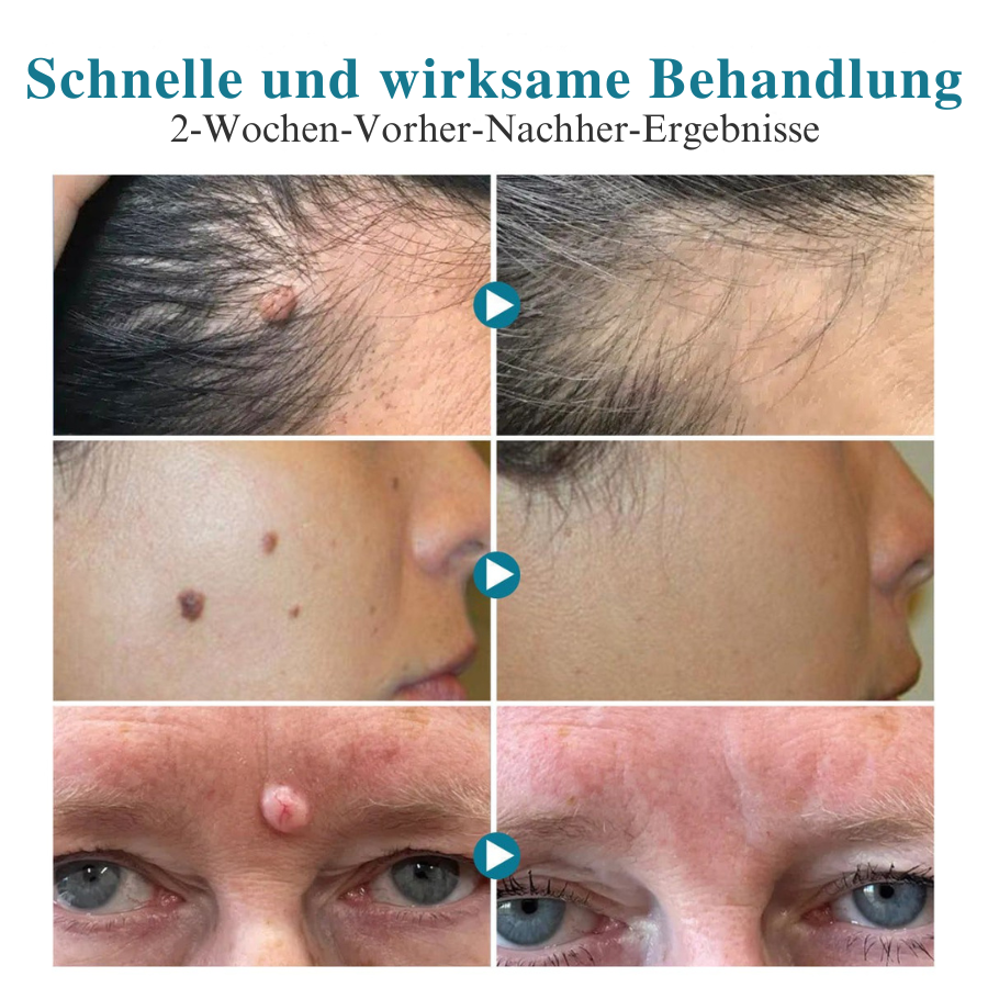 Bikenda® LumeSkin Muttermal und Warze Entfernung Laserstif