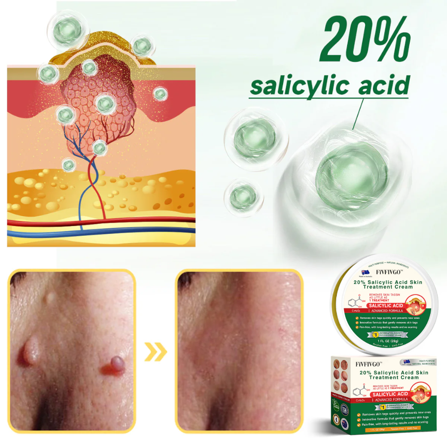 Fivfivgo™ 20% Salicylsäure Hautbehandlungscreme