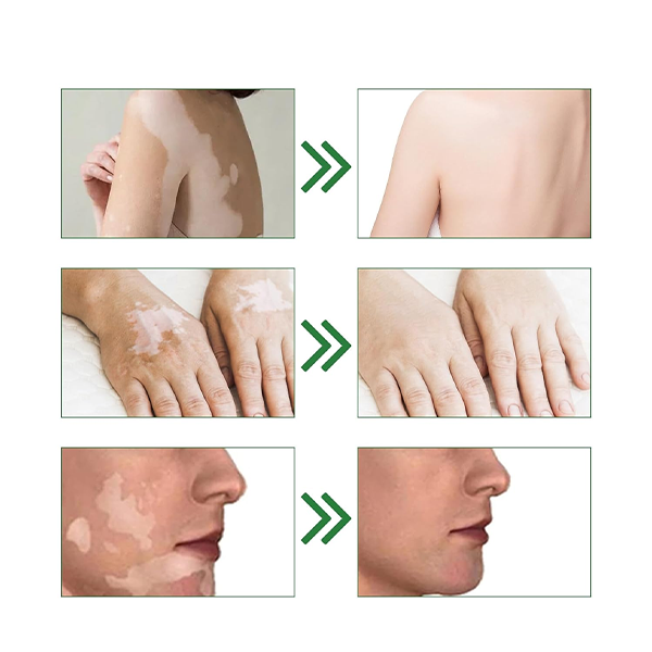 Fivfivgo™ Squalene Vitiligo-Behandlung Creme