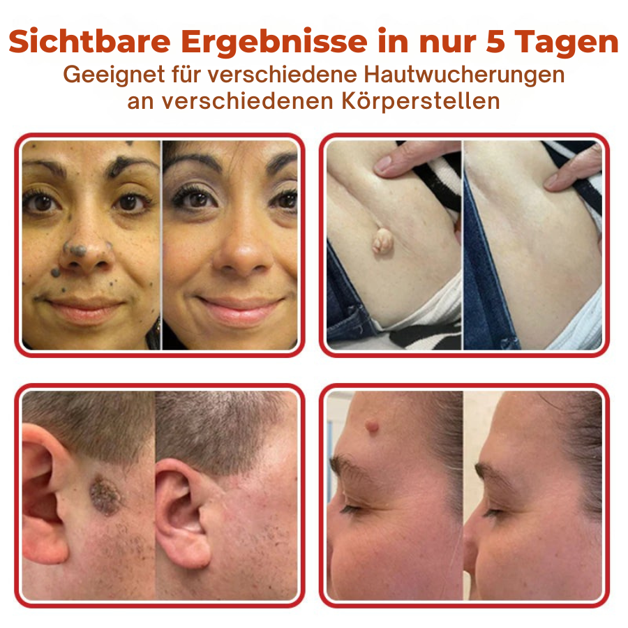 Fivfivgo® MikroNadel Botanisch Haut Tag Entfernung Patch 🇩🇪 Hergestellt in der Germany