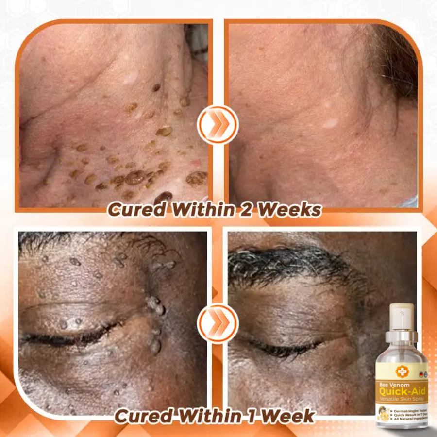 Fivfivgo™ Bee Venom Quick Relief Versatile Skin Spray 🇩🇪 Dermatologist Approved