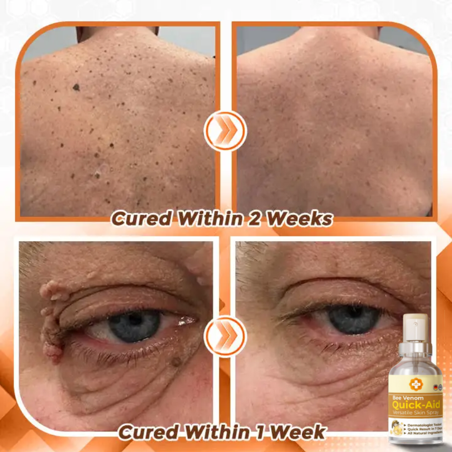 Fivfivgo™ Bee Venom Quick Relief Versatile Skin Spray 🇩🇪 Dermatologist Approved