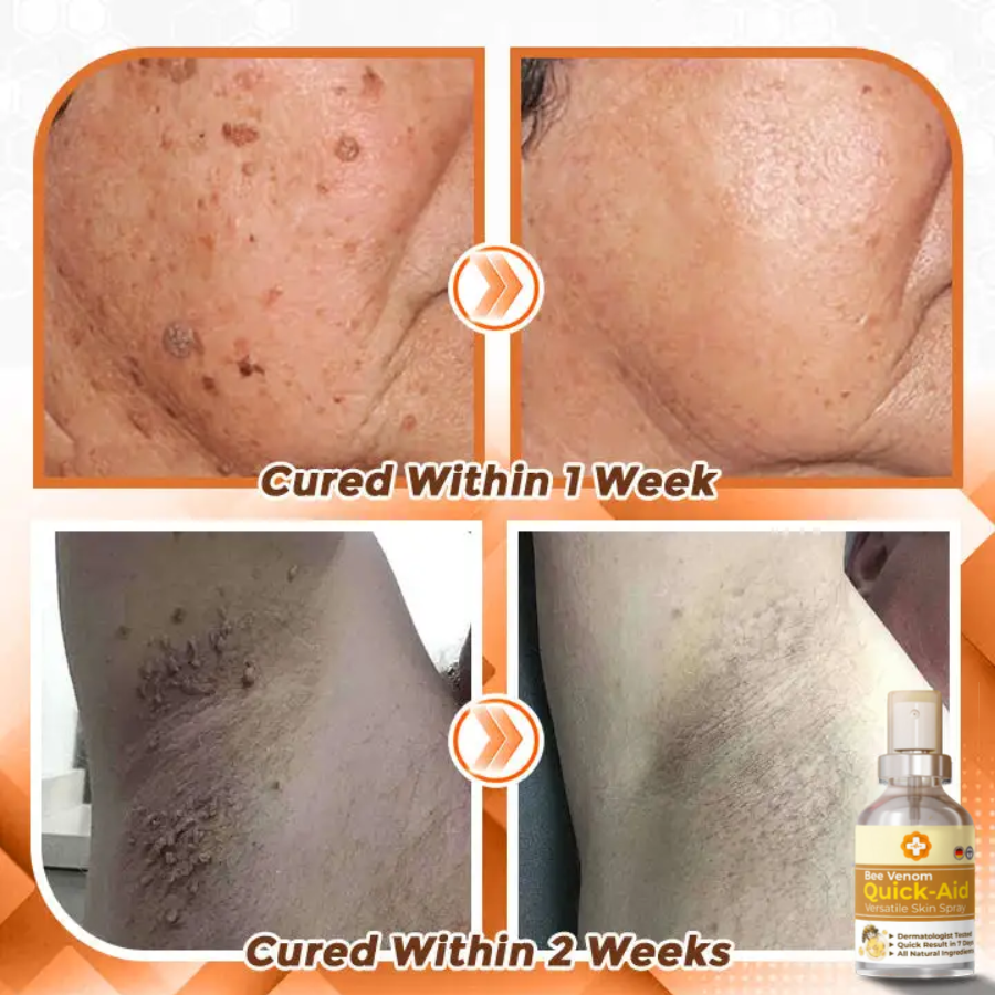 Fivfivgo™ Bee Venom Quick Relief Versatile Skin Spray 🇩🇪 Dermatologist Approved