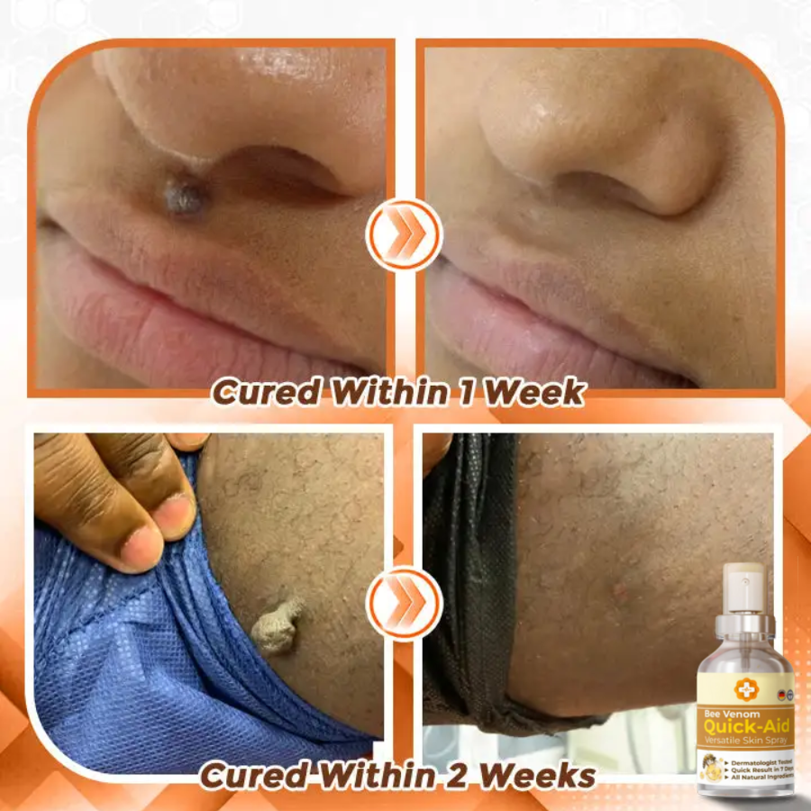 Fivfivgo™ Bee Venom Quick Relief Versatile Skin Spray 🇩🇪 Dermatologist Approved