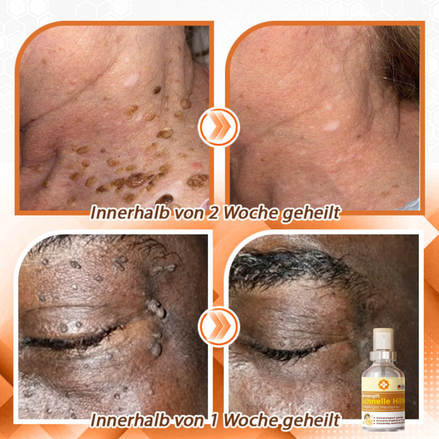 Fivfivgo™ Bienengift Schnelle Hilfe Vielseitiges Hautspray🇩🇪 Dermatologisch geprüft