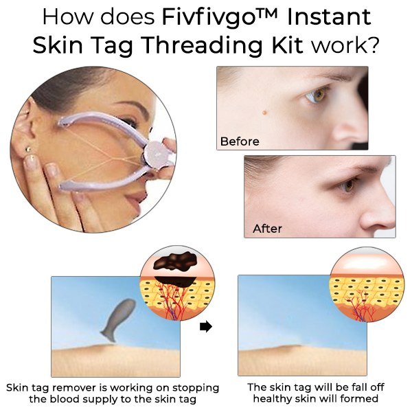 Fivfivgo™ Instant Skin Tag Threading Kit