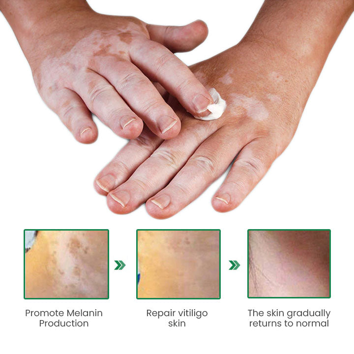 Fivfivgo™ VitiligoFix Revitalize eliksiiri