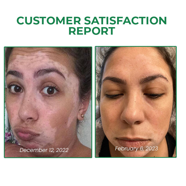 Fivfivgo™ VitiligoFix Élixir de revitalisation