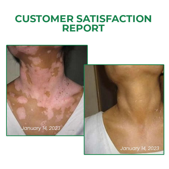 Fivfivgo™ VitiligoFix Revitalize eliksiiri