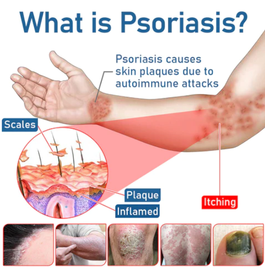 Fivfivgo™ Psoriasis Crème Hydratante et Apaisante