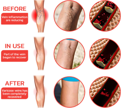 Fivfivgo™ VeinHealing suonikohjujen hoito Spray