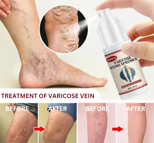 Fivfivgo™ VeinHealing Varicose Veins Treatment Spray