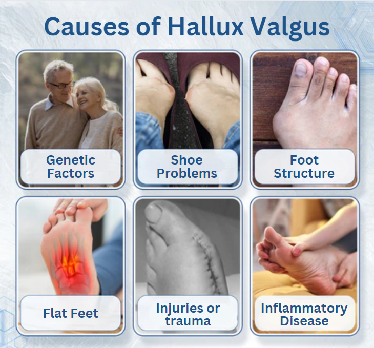 Fivfivgo™ Aide à la correction de l'hallux-valgus