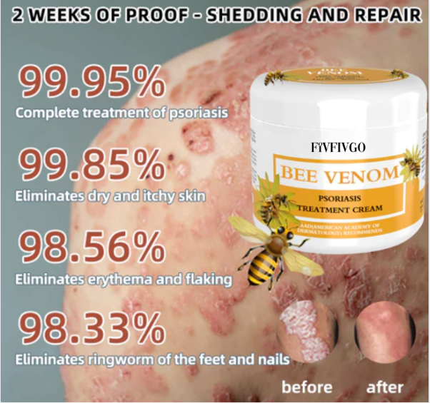 Fivfivgo™ BeeVenom Psoriasis-Lösungs-Creme