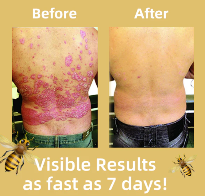 Fivfivgo™ BeeVenom Psoriasis Solution Cream