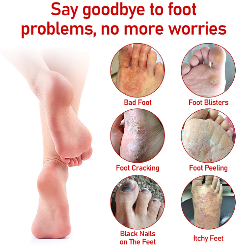 Fivfivgo™ Fongus médical de l'ongle Spray pour les pieds