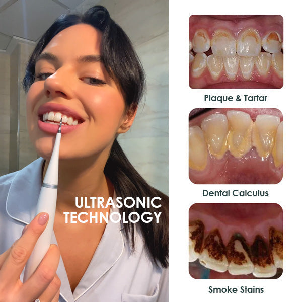 Fivfivgo™ Nettoyeur de Dents à Ultrasons