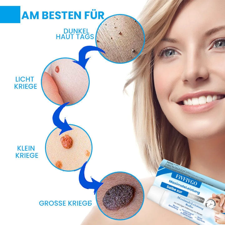 Fivfivgo™ MaximaleLeistung Salbe zur sofortigen Entfernung von Warzen