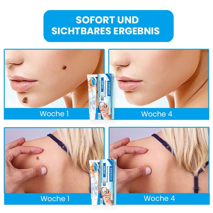 Fivfivgo™ MaximaleLeistung Salbe zur sofortigen Entfernung von Warzen
