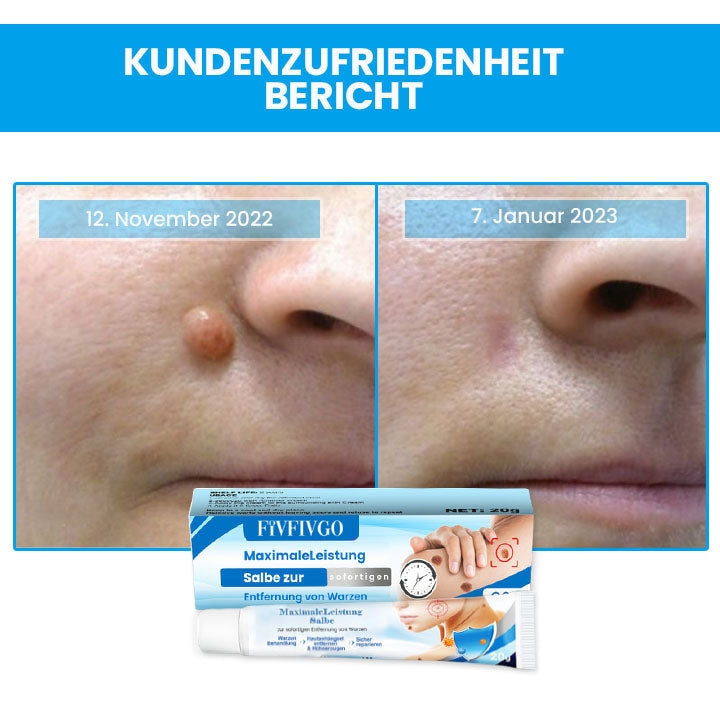 Fivfivgo™ MaximaleLeistung Salbe zur sofortigen Entfernung von Warzen