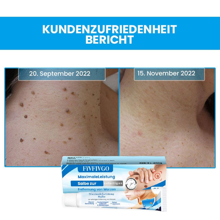 Fivfivgo™ MaximaleLeistung Salbe zur sofortigen Entfernung von Warzen