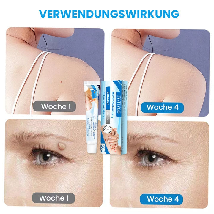 Fivfivgo™ MaximaleLeistung Salbe zur sofortigen Entfernung von Warzen