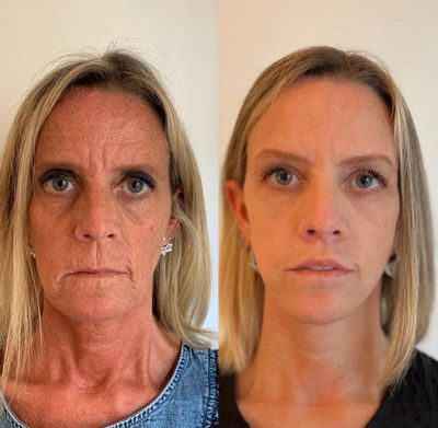 Fivfivgo™ Vitamin C Anti-Åldrande Ansiktsserum