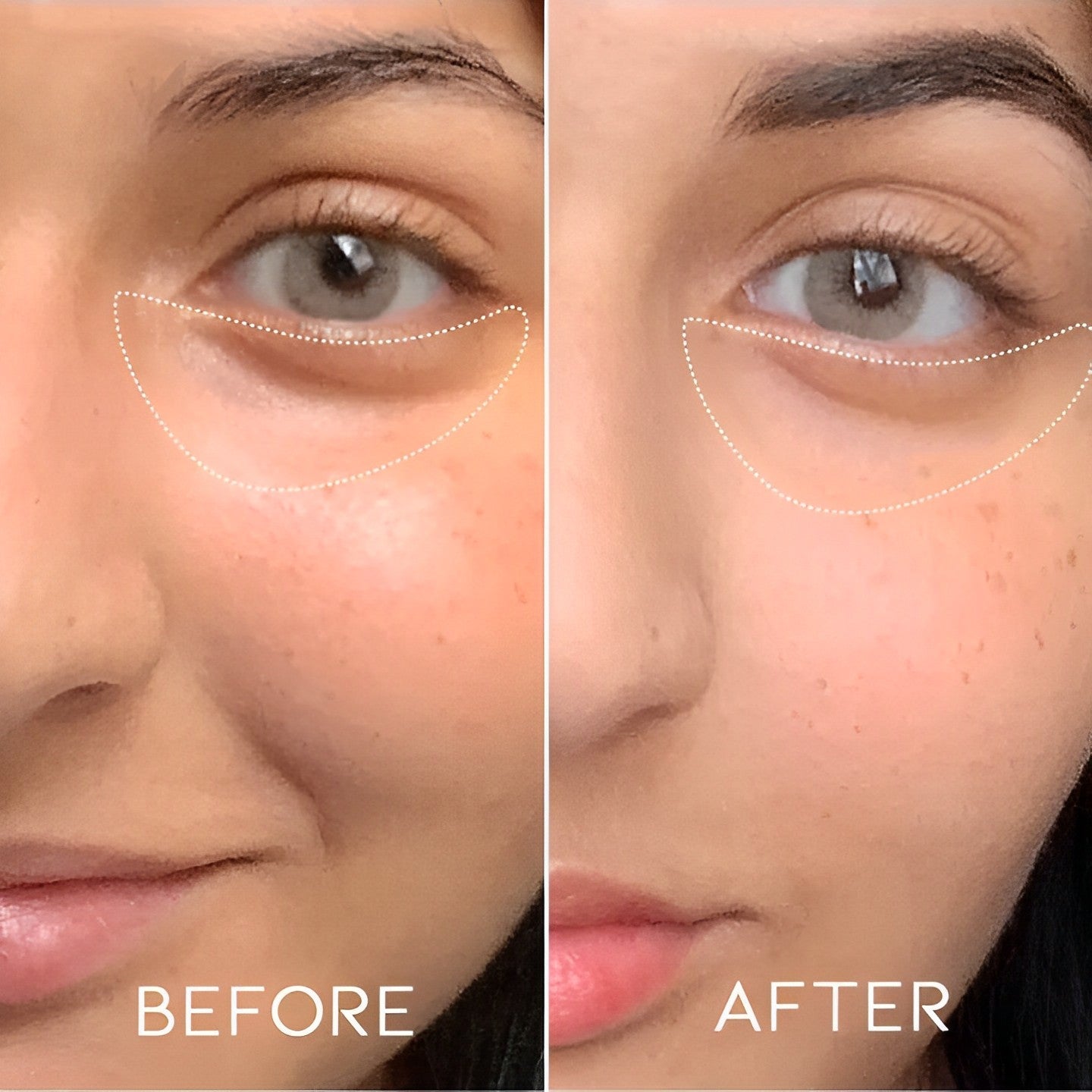 Micro-darts Anti-Wrinkle Patches Personal Care Every Day And Night 