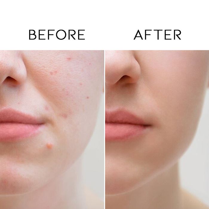 Day & Night Acne Treatment Patches Personal Care Every Day And Night 