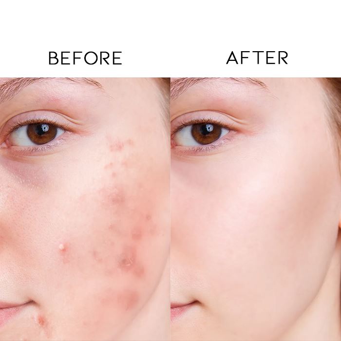 Tea Tree Ance Treatment Cream Skin Care Every Day And Night 