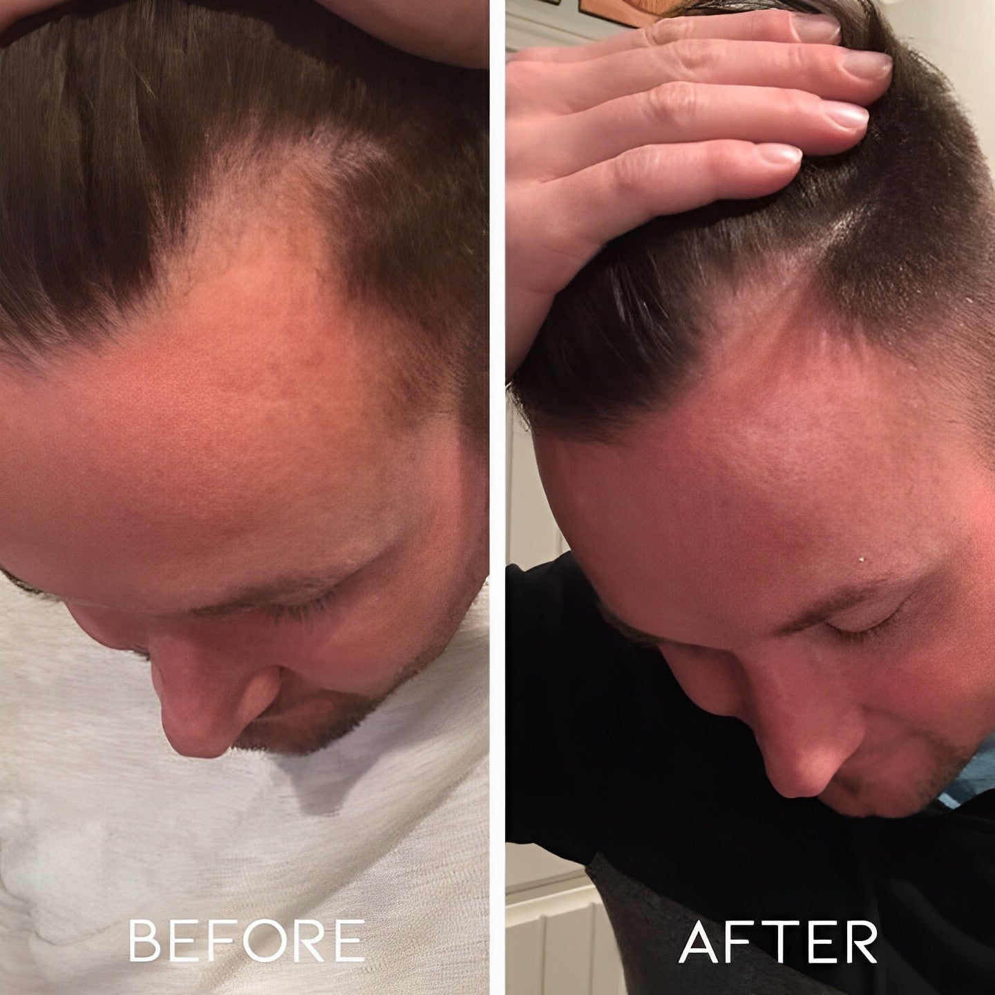 Microneedling Face Roller Personal Care Every Day And Night 