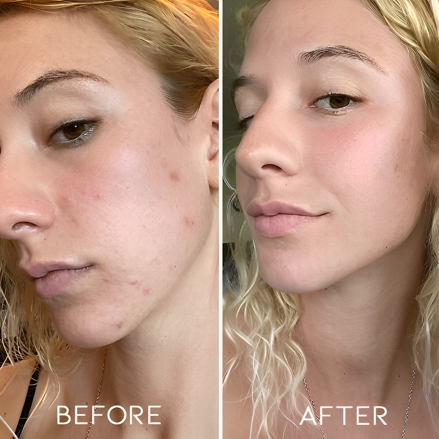 Microneedling Face Roller Personal Care Every Day And Night 