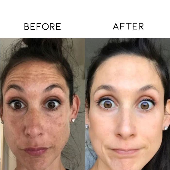 20% Vitamin Dark Spots Removal Serum Skin Care Every Day And Night 